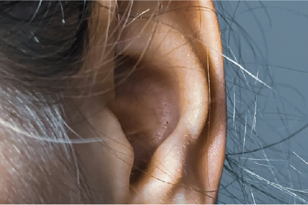 hyperacusis en tinnitus leeuwarden